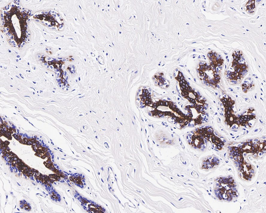 Immunohistochemical analysis of paraffin-embedded human breast tissue with Rabbit anti-Cytokeratin 7 antibody (ET1609-62) at 1/1,500 dilution.<br />
<br />
The section was pre-treated using heat mediated antigen retrieval with Tris-EDTA buffer (pH 9.0) for 20 minutes. The tissues were blocked in 1% BSA for 20 minutes at room temperature, washed with ddH2O and PBS, and then probed with the primary antibody (ET1609-62) at 1/1,500 dilution for 1 hour at room temperature. The detection was performed using an HRP conjugated compact polymer system. DAB was used as the chromogen. Tissues were counterstained with hematoxylin and mounted with DPX.
