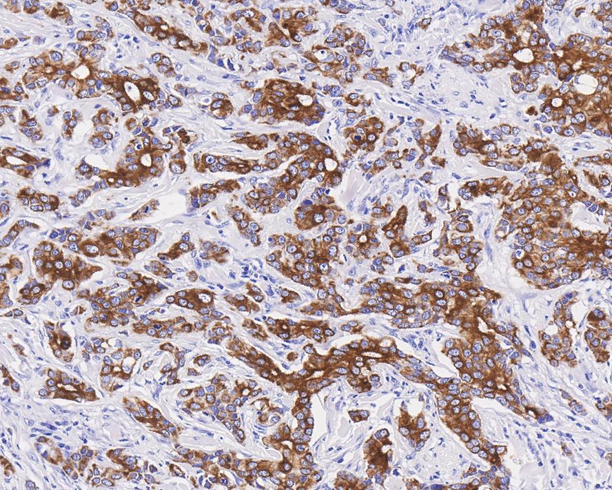 Immunohistochemical analysis of paraffin-embedded human breast carcinoma tissue with Rabbit anti-Cytokeratin 7 antibody (ET1609-62) at 1/1,500 dilution.<br />
<br />
The section was pre-treated using heat mediated antigen retrieval with Tris-EDTA buffer (pH 9.0) for 20 minutes. The tissues were blocked in 1% BSA for 20 minutes at room temperature, washed with ddH2O and PBS, and then probed with the primary antibody (ET1609-62) at 1/1,500 dilution for 1 hour at room temperature. The detection was performed using an HRP conjugated compact polymer system. DAB was used as the chromogen. Tissues were counterstained with hematoxylin and mounted with DPX.