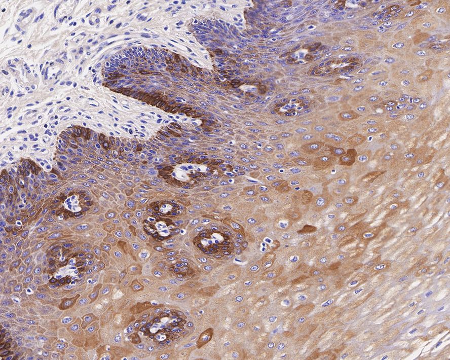 Immunohistochemical analysis of paraffin-embedded human esophagus tissue with Rabbit anti-Cytokeratin 16 antibody (ET1610-17) at 1/1,500 dilution.<br />
<br />
The section was not undergone antigen retrieval. The tissues were blocked in 1% BSA for 20 minutes at room temperature, washed with ddH2O and PBS, and then probed with the primary antibody (ET1610-17) at 1/1,500 dilution for 1 hour at room temperature. The detection was performed using an HRP conjugated compact polymer system. DAB was used as the chromogen. Tissues were counterstained with hematoxylin and mounted with DPX.