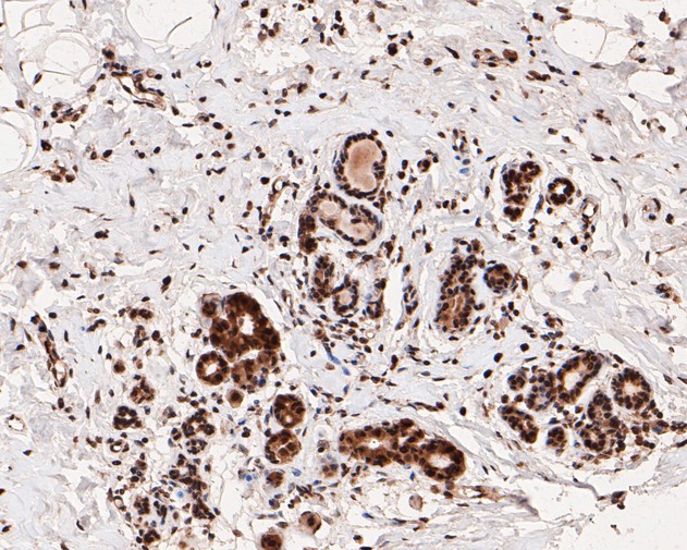 Immunohistochemical analysis of paraffin-embedded human breast tissue using anti-Phospho-Estrogen Receptor alpha(S118) antibody. The section was pre-treated using heat mediated antigen retrieval with sodium citrate buffer (pH 6.0) for 20 minutes. The tissues were blocked in 1% BSA for 30 minutes at room temperature, washed with ddH2O and PBS, and then probed with the primary antibody (ET1610-32, 1/50)  for 30 minutes at room temperature. The detection was performed using an HRP conjugated compact polymer system. DAB was used as the chromogen. Tissues were counterstained with hematoxylin and mounted with DPX.