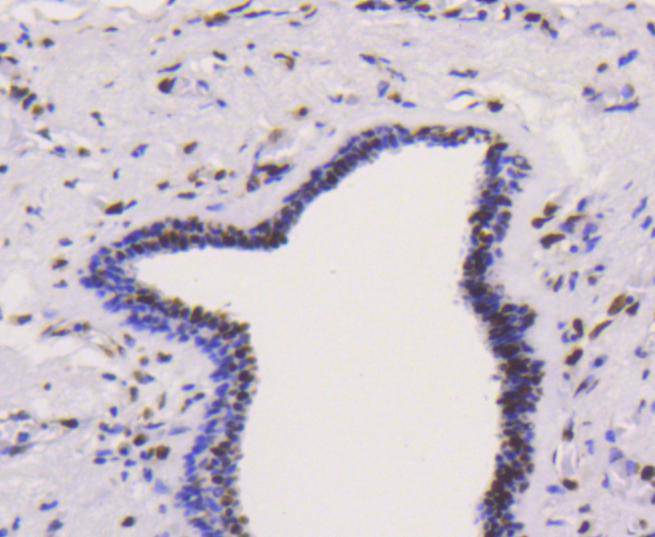 Immunohistochemical analysis of paraffin-embedded human breast carcinoma tissue using anti-hnRNP K antibody. The section was pre-treated using heat mediated antigen retrieval with Tris-EDTA buffer (pH 8.0-8.4) for 20 minutes.The tissues were blocked in 5% BSA for 30 minutes at room temperature, washed with ddH2O and PBS, and then probed with the primary antibody (ET1610-38, 1/50) for 30 minutes at room temperature. The detection was performed using an HRP conjugated compact polymer system. DAB was used as the chromogen. Tissues were counterstained with hematoxylin and mounted with DPX.