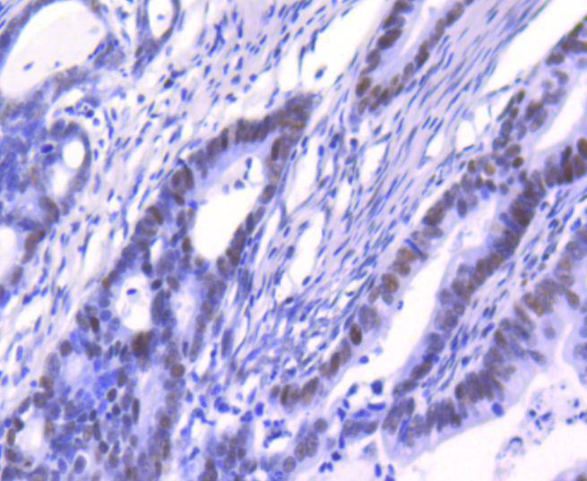 Immunohistochemical analysis of paraffin-embedded human colon cancer tissue with Rabbit anti-Ku80 antibody (ET1610-40) at 1/50 dilution.<br />
<br />
The section was pre-treated using heat mediated antigen retrieval with Tris-EDTA buffer (pH 8.0-8.4) for 20 minutes. The tissues were blocked in 1% BSA for 20 minutes at room temperature, washed with ddH2O and PBS, and then probed with the primary antibody (ET1610-40) at 1/50 dilution for 1 hour at room temperature. The detection was performed using an HRP conjugated compact polymer system. DAB was used as the chromogen. Tissues were counterstained with hematoxylin and mounted with DPX.