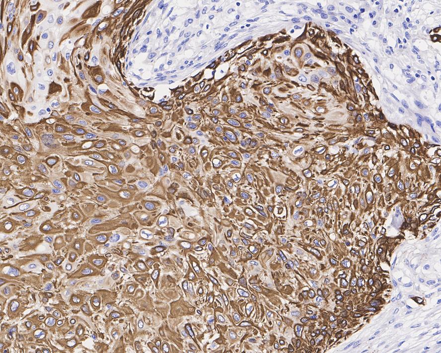 Immunohistochemical analysis of paraffin-embedded human breast carcinoma tissue using anti-Cytokeratin 14 antibody. The section was pre-treated using heat mediated antigen retrieval with Tris-EDTA buffer (pH 8.0-8.4) for 20 minutes.The tissues were blocked in 5% BSA for 30 minutes at room temperature, washed with ddH2O and PBS, and then probed with the primary antibody (ET1610-42, 1/50) for 30 minutes at room temperature. The detection was performed using an HRP conjugated compact polymer system. DAB was used as the chromogen. Tissues were counterstained with hematoxylin and mounted with DPX.