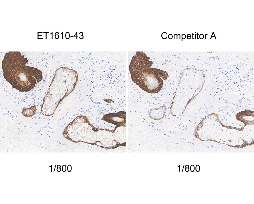 Immunohistochemical analysis of paraffin-embedded human lung carcinoma tissue using anti-Cytokeratin 5 antibody. The section was pre-treated using heat mediated antigen retrieval with Tris-EDTA buffer (pH 9.0) for 20 minutes.The tissues were blocked in 5% BSA for 30 minutes at room temperature, washed with ddH2O and PBS, and then probed with the primary antibody (ET1610-43, 1/200) for 30 minutes at room temperature. The detection was performed using an HRP conjugated compact polymer system. DAB was used as the chromogen. Tissues were counterstained with hematoxylin and mounted with DPX.