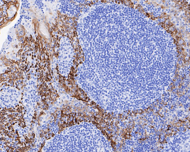Immunohistochemical analysis of paraffin-embedded human breast carcinoma tissue using anti-Cytokeratin 5 antibody. The section was pre-treated using heat mediated antigen retrieval with Tris-EDTA buffer (pH 9.0) for 20 minutes.The tissues were blocked in 5% BSA for 30 minutes at room temperature, washed with ddH2O and PBS, and then probed with the primary antibody (ET1610-43, 1/50) for 30 minutes at room temperature. The detection was performed using an HRP conjugated compact polymer system. DAB was used as the chromogen. Tissues were counterstained with hematoxylin and mounted with DPX.