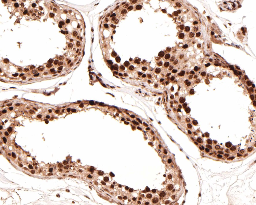 Immunohistochemical analysis of paraffin-embedded human fallopian tube tissue with Rabbit anti-Wilms Tumor Protein antibody (ET1610-45) at 1/100 dilution.<br />
<br />
The section was pre-treated using heat mediated antigen retrieval with sodium citrate buffer (pH 6.0) for 2 minutes. The tissues were blocked in 1% BSA for 20 minutes at room temperature, washed with ddH2O and PBS, and then probed with the primary antibody (ET1610-45) at 1/100 dilution for 1 hour at room temperature. The detection was performed using an HRP conjugated compact polymer system. DAB was used as the chromogen. Tissues were counterstained with hematoxylin and mounted with DPX.