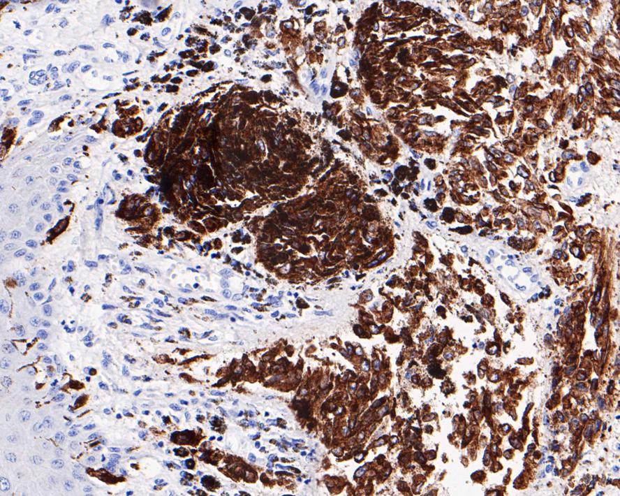 Immunohistochemical analysis of paraffin-embedded human melanoma tissue using anti-MelanA antibody.<br />
<br />
The section was pre-treated using heat mediated antigen retrieval with Tris-EDTA buffer (pH 8.0-8.4) for 20 minutes.The tissues were blocked in 5% BSA for 30 minutes at room temperature, washed with ddH2O and PBS, and then probed with the primary antibody (ET1610-47, 1/200) for 30 minutes at room temperature. The detection was performed using an HRP conjugated compact polymer system. DAB was used as the chromogen. Tissues were counterstained with hematoxylin and mounted with DPX.