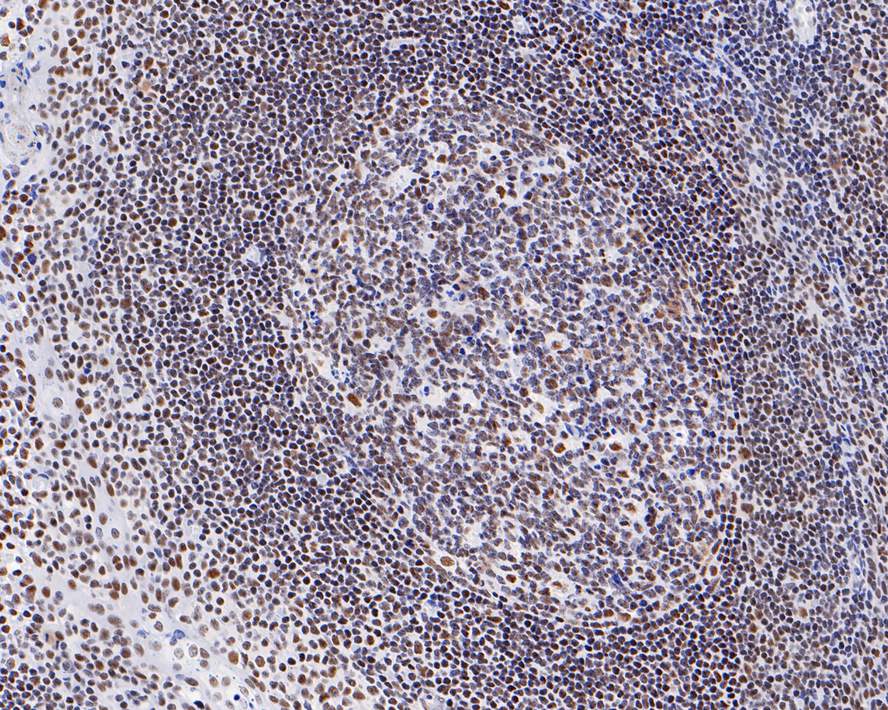 Immunohistochemical analysis of paraffin-embedded human tonsil tissue with Rabbit anti-HDAC3 antibody (ET1610-5) at 1/200 dilution.<br />
<br />
The section was pre-treated using heat mediated antigen retrieval with sodium citrate buffer (pH 6.0) for 2 minutes. The tissues were blocked in 1% BSA for 20 minutes at room temperature, washed with ddH2O and PBS, and then probed with the primary antibody (ET1610-5) at 1/200 dilution for 1 hour at room temperature. The detection was performed using an HRP conjugated compact polymer system. DAB was used as the chromogen. Tissues were counterstained with hematoxylin and mounted with DPX.