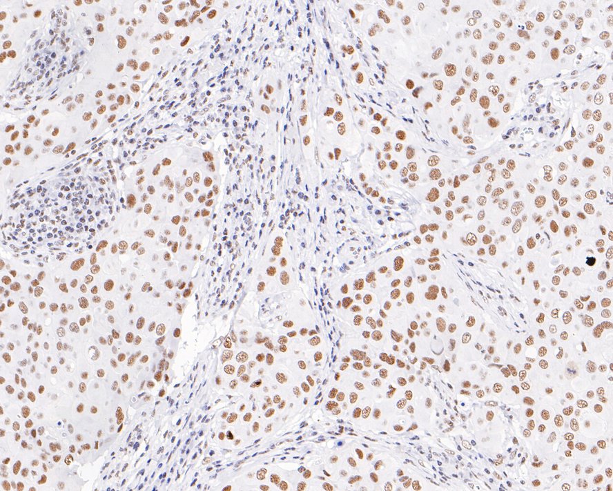 Immunohistochemical analysis of paraffin-embedded human breast carcinoma tissue with Rabbit anti-HDAC3 antibody (ET1610-5) at 1/1,000 dilution.<br />
<br />
The section was pre-treated using heat mediated antigen retrieval with sodium citrate buffer (pH 6.0) for 2 minutes. The tissues were blocked in 1% BSA for 20 minutes at room temperature, washed with ddH2O and PBS, and then probed with the primary antibody (ET1610-5) at 1/1,000 dilution for 1 hour at room temperature. The detection was performed using an HRP conjugated compact polymer system. DAB was used as the chromogen. Tissues were counterstained with hematoxylin and mounted with DPX.