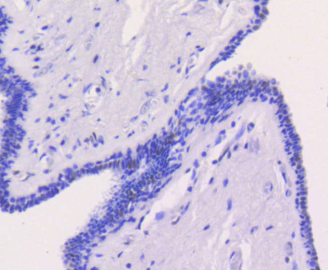 Immunohistochemical analysis of paraffin-embedded human breast carcinoma tissue using anti-Chk2 antibody. The section was pre-treated using heat mediated antigen retrieval with Tris-EDTA buffer (pH 8.0-8.4) for 20 minutes.The tissues were blocked in 5% BSA for 30 minutes at room temperature, washed with ddH2O and PBS, and then probed with the primary antibody (ET1610-52, 1/50) for 30 minutes at room temperature. The detection was performed using an HRP conjugated compact polymer system. DAB was used as the chromogen. Tissues were counterstained with hematoxylin and mounted with DPX.