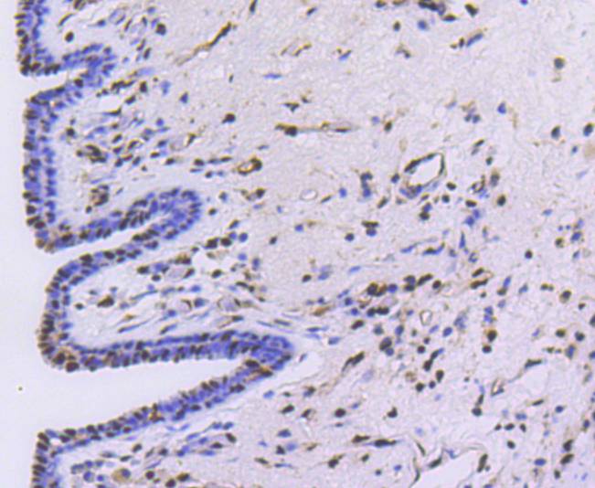 Immunohistochemical analysis of paraffin-embedded human breast carcinoma tissue using anti-PRP19 antibody. Counter stained with hematoxylin.