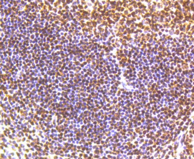 Immunohistochemical analysis of paraffin-embedded human lung adenocarcinoma tissue using anti-Phospho-SMC1(S957) antibody. The section was pre-treated using heat mediated antigen retrieval with Tris-EDTA buffer (pH 8.0-8.4) for 20 minutes.The tissues were blocked in 5% BSA for 30 minutes at room temperature, washed with ddH2O and PBS, and then probed with the primary antibody (ET1610-55, 1/200) for 30 minutes at room temperature. The detection was performed using an HRP conjugated compact polymer system. DAB was used as the chromogen. Tissues were counterstained with hematoxylin and mounted with DPX.