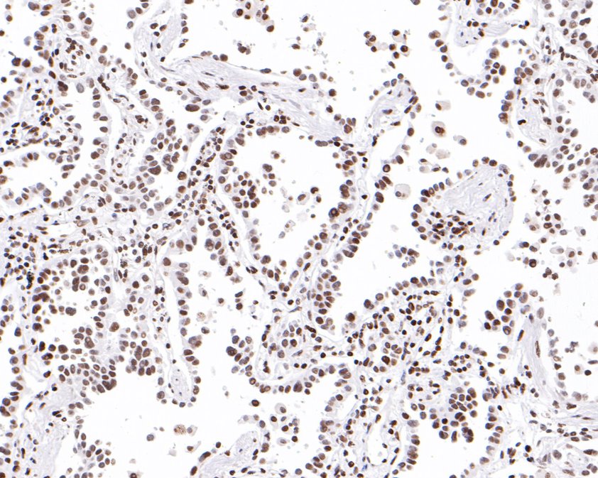 Immunohistochemical analysis of paraffin-embedded human breast carcinoma tissue using anti-Phospho-SMC1(S957) antibody. The section was pre-treated using heat mediated antigen retrieval with Tris-EDTA buffer (pH 8.0-8.4) for 20 minutes.The tissues were blocked in 5% BSA for 30 minutes at room temperature, washed with ddH2O and PBS, and then probed with the primary antibody (ET1610-55, 1/50) for 30 minutes at room temperature. The detection was performed using an HRP conjugated compact polymer system. DAB was used as the chromogen. Tissues were counterstained with hematoxylin and mounted with DPX.