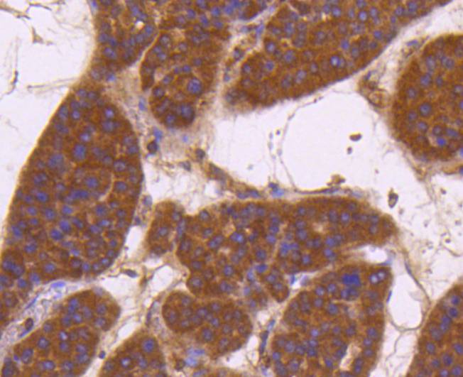 Immunohistochemical analysis of paraffin-embedded human liver carcinoma tissue using anti-CD13 antibody. The section was pre-treated using heat mediated antigen retrieval with Tris-EDTA buffer (pH 8.0-8.4) for 20 minutes.The tissues were blocked in 5% BSA for 30 minutes at room temperature, washed with ddH2O and PBS, and then probed with the primary antibody (ET1610-59, 1/50) for 30 minutes at room temperature. The detection was performed using an HRP conjugated compact polymer system. DAB was used as the chromogen. Tissues were counterstained with hematoxylin and mounted with DPX.
