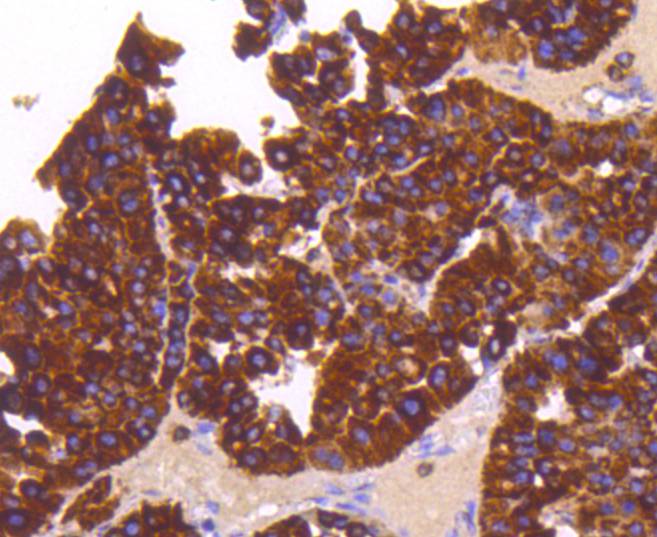Immunohistochemical analysis of paraffin-embedded human liver cancer tissue using anti-Sonic Hedgehog Protein antibody. Counter stained with hematoxylin.
