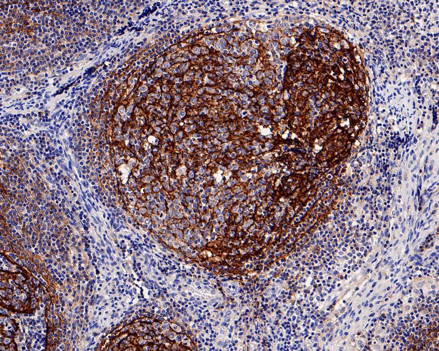 Immunohistochemical analysis of paraffin-embedded human lymph nodes tissue with Rabbit anti-CD21 antibody (ET1610-61) at 1/800 dilution.<br />
<br />
The section was pre-treated using heat mediated antigen retrieval with Tris-EDTA buffer (pH 9.0) for 20 minutes. The tissues were blocked in 1% BSA for 20 minutes at room temperature, washed with ddH2O and PBS, and then probed with the primary antibody (ET1610-61) at 1/800 dilution for 1 hour at room temperature. The detection was performed using an HRP conjugated compact polymer system. DAB was used as the chromogen. Tissues were counterstained with hematoxylin and mounted with DPX.