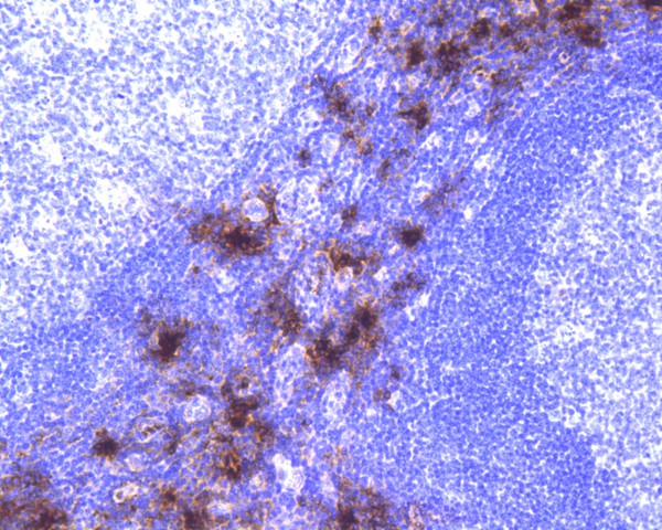 Immunohistochemical analysis of paraffin-embedded human prostate carcinoma tissue using anti-Mast Cell Tryptase antibody. The section was pre-treated using heat mediated antigen retrieval with Tris-EDTA buffer (pH 8.0-8.4) for 20 minutes.The tissues were blocked in 5% BSA for 30 minutes at room temperature, washed with ddH2O and PBS, and then probed with the primary antibody (ET1610-64, 1/50) for 30 minutes at room temperature. The detection was performed using an HRP conjugated compact polymer system. DAB was used as the chromogen. Tissues were counterstained with hematoxylin and mounted with DPX.