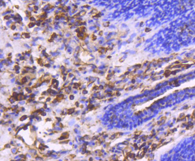 Immunohistochemical analysis of paraffin-embedded human breast carcinoma tissue using anti-Moesin antibody. The section was pre-treated using heat mediated antigen retrieval with Tris-EDTA buffer (pH 8.0-8.4) for 20 minutes.The tissues were blocked in 5% BSA for 30 minutes at room temperature, washed with ddH2O and PBS, and then probed with the primary antibody (ET1610-65, 1/50) for 30 minutes at room temperature. The detection was performed using an HRP conjugated compact polymer system. DAB was used as the chromogen. Tissues were counterstained with hematoxylin and mounted with DPX.