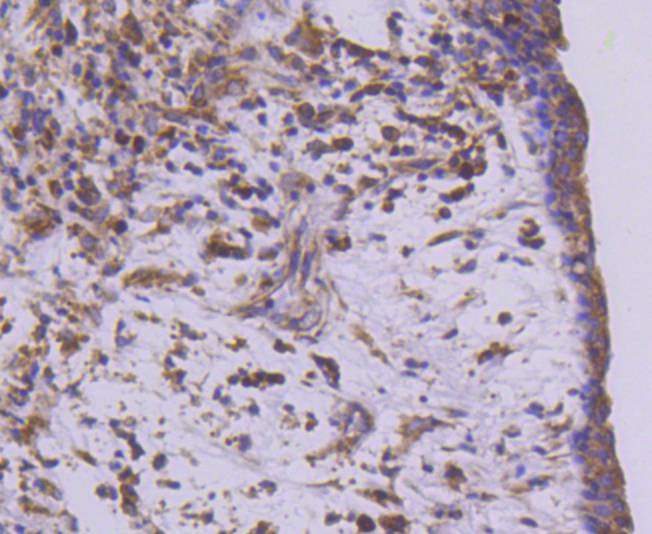 Immunohistochemical analysis of paraffin-embedded human breast carcinoma tissue using anti-MEKK2 antibody. Counter stained with hematoxylin.