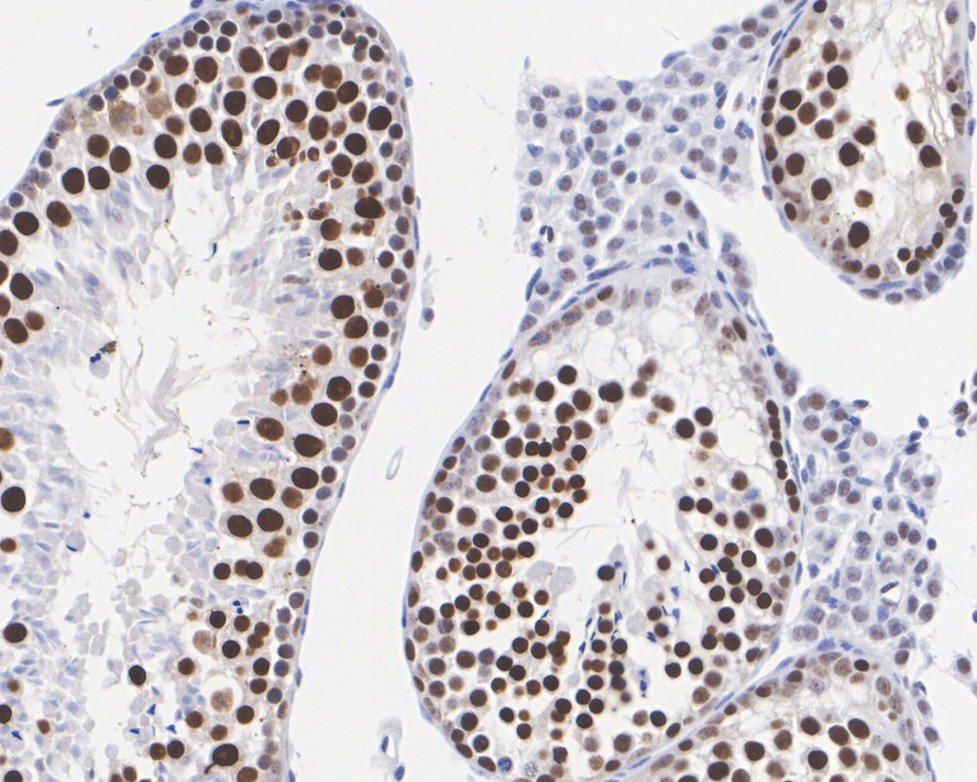 Immunohistochemical analysis of paraffin-embedded human breast carcinoma tissue using anti-TCF7L2 antibody. The section was pre-treated using heat mediated antigen retrieval with Tris-EDTA buffer (pH 8.0-8.4) for 20 minutes.The tissues were blocked in 5% BSA for 30 minutes at room temperature, washed with ddH2O and PBS, and then probed with the primary antibody (ET1610-73, 1/50) for 30 minutes at room temperature. The detection was performed using an HRP conjugated compact polymer system. DAB was used as the chromogen. Tissues were counterstained with hematoxylin and mounted with DPX.