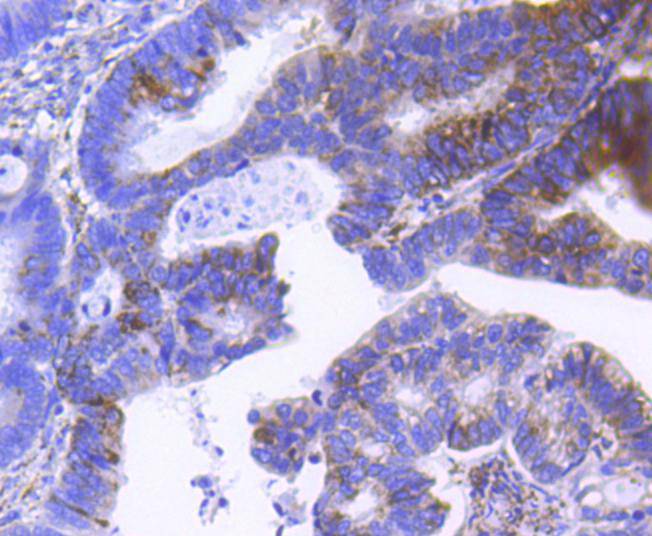 Immunohistochemical analysis of paraffin-embedded human colon carcinoma tissue using anti-SCF antibody. The section was pre-treated using heat mediated antigen retrieval with Tris-EDTA buffer (pH 8.0-8.4) for 20 minutes.The tissues were blocked in 5% BSA for 30 minutes at room temperature, washed with ddH2O and PBS, and then probed with the primary antibody (ET1610-77, 1/50) for 30 minutes at room temperature. The detection was performed using an HRP conjugated compact polymer system. DAB was used as the chromogen. Tissues were counterstained with hematoxylin and mounted with DPX.