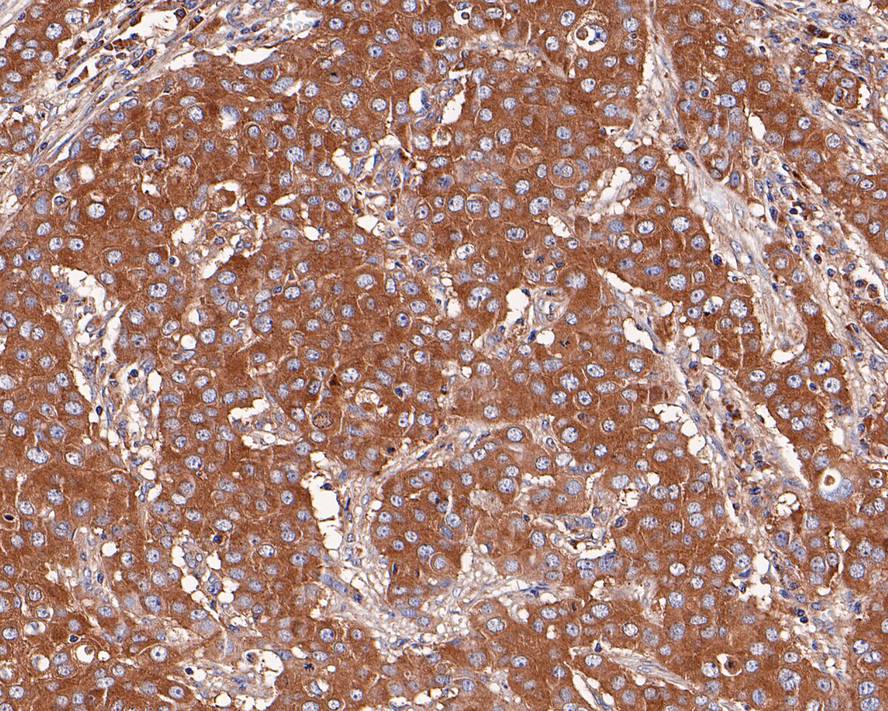 Immunohistochemical analysis of paraffin-embedded human breast carcinoma tissue with Rabbit anti-RALBP1 antibody (ET1610-88) at 1/200 dilution.<br />
<br />
The section was pre-treated using heat mediated antigen retrieval with Tris-EDTA buffer (pH 9.0) for 20 minutes. The tissues were blocked in 1% BSA for 20 minutes at room temperature, washed with ddH2O and PBS, and then probed with the primary antibody (ET1610-88) at 1/200 dilution for 1 hour at room temperature. The detection was performed using an HRP conjugated compact polymer system. DAB was used as the chromogen. Tissues were counterstained with hematoxylin and mounted with DPX.