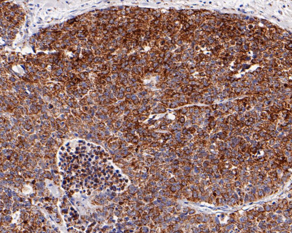 Immunohistochemical analysis of paraffin-embedded human lung carcinoma tissue using anti-NLRP3 antibody. The section was pre-treated using heat mediated antigen retrieval with Tris-EDTA buffer (pH 9.0) for 20 minutes.The tissues were blocked in 1% BSA for 30 minutes at room temperature, washed with ddH2O and PBS, and then probed with the primary antibody (ET1610-93, 1/50) for 30 minutes at room temperature. The detection was performed using an HRP conjugated compact polymer system. DAB was used as the chromogen. Tissues were counterstained with hematoxylin and mounted with DPX.