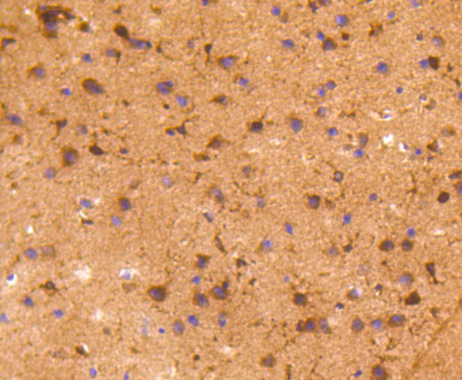 Immunohistochemical analysis of paraffin-embedded human breast carcinoma tissue using anti-COX1/Cyclooxygenase 1 antibody. The section was pre-treated using heat mediated antigen retrieval with Tris-EDTA buffer (pH 8.0-8.4) for 20 minutes.The tissues were blocked in 5% BSA for 30 minutes at room temperature, washed with ddH2O and PBS, and then probed with the primary antibody (ET1610-98, 1/50) for 30 minutes at room temperature. The detection was performed using an HRP conjugated compact polymer system. DAB was used as the chromogen. Tissues were counterstained with hematoxylin and mounted with DPX.