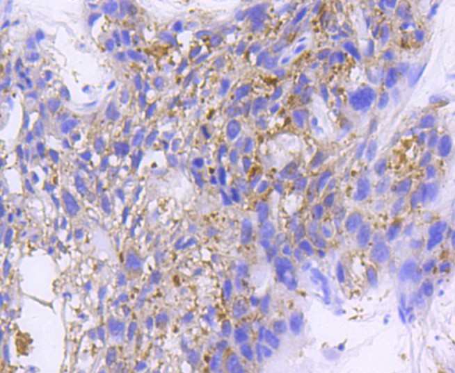 Immunohistochemical analysis of paraffin-embedded human breast carcinoma tissue using anti-IKB beta antibody. The section was pre-treated using heat mediated antigen retrieval with Tris-EDTA buffer (pH 9.0) for 20 minutes.The tissues were blocked in 1% BSA for 30 minutes at room temperature, washed with ddH2O and PBS, and then probed with the primary antibody (ET1611-1, 1/50) for 30 minutes at room temperature. The detection was performed using an HRP conjugated compact polymer system. DAB was used as the chromogen. Tissues were counterstained with hematoxylin and mounted with DPX.