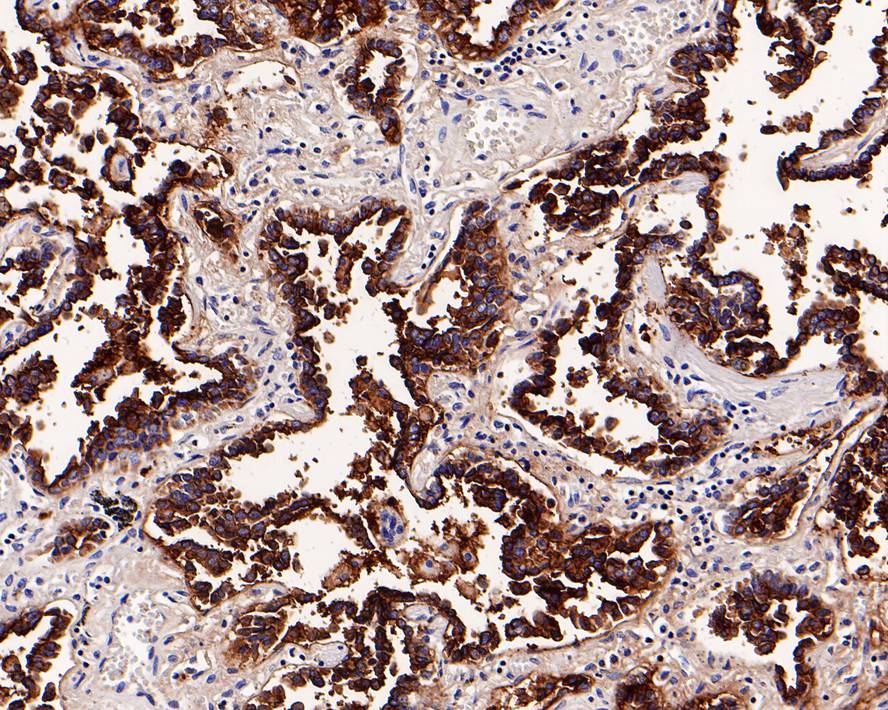 Immunohistochemical analysis of paraffin-embedded human endometrial carcinoma tissue with Rabbit anti-MUC1 antibody (ET1611-14) at 1/1,000 dilution.<br />
<br />
The section was pre-treated using heat mediated antigen retrieval with Tris-EDTA buffer (pH 9.0) for 20 minutes. The tissues were blocked in 1% BSA for 20 minutes at room temperature, washed with ddH2O and PBS, and then probed with the primary antibody (ET1611-14) at 1/1,000 dilution for 1 hour at room temperature. The detection was performed using an HRP conjugated compact polymer system. DAB was used as the chromogen. Tissues were counterstained with hematoxylin and mounted with DPX.