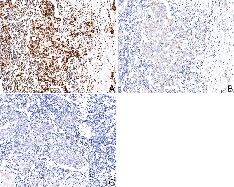 Immunohistochemical analysis of paraffin-embedded human lung carcinoma tissue with Rabbit anti-Phospho-STAT1(S727) antibody (ET1611-20) at 1/500 dilution.<br />
<br />
The section was pre-treated using heat mediated antigen retrieval with Tris-EDTA buffer (pH 9.0) for 20 minutes. The tissues were blocked in 1% BSA for 20 minutes at room temperature, washed with ddH2O and PBS, and then probed with the primary antibody (ET1611-20) at 1/500 dilution for 1 hour at room temperature. The detection was performed using an HRP conjugated compact polymer system. DAB was used as the chromogen. Tissues were counterstained with hematoxylin and mounted with DPX.
