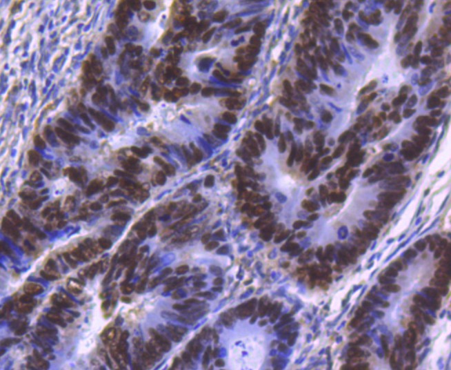Immunohistochemical analysis of paraffin-embedded human colon carcinoma tissue using anti-HNF-4-alpha antibody. The section was pre-treated using heat mediated antigen retrieval with Tris-EDTA buffer (pH 8.0-8.4) for 20 minutes.The tissues were blocked in 5% BSA for 30 minutes at room temperature, washed with ddH2O and PBS, and then probed with the primary antibody (ET1611-43, 1/50) for 30 minutes at room temperature. The detection was performed using an HRP conjugated compact polymer system. DAB was used as the chromogen. Tissues were counterstained with hematoxylin and mounted with DPX.