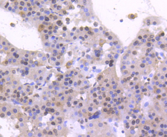 Immunohistochemical analysis of paraffin-embedded human liver carcinoma tissue using anti-HNF-4-alpha antibody. The section was pre-treated using heat mediated antigen retrieval with Tris-EDTA buffer (pH 8.0-8.4) for 20 minutes.The tissues were blocked in 5% BSA for 30 minutes at room temperature, washed with ddH2O and PBS, and then probed with the primary antibody (ET1611-43, 1/50) for 30 minutes at room temperature. The detection was performed using an HRP conjugated compact polymer system. DAB was used as the chromogen. Tissues were counterstained with hematoxylin and mounted with DPX.