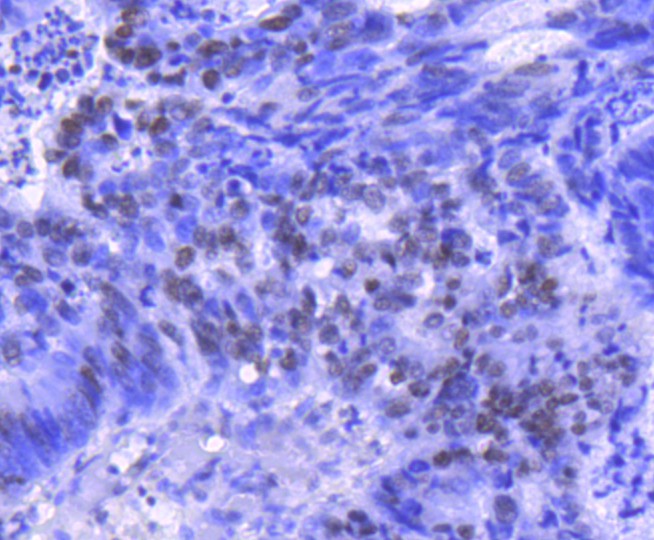 Immunohistochemical analysis of paraffin-embedded human colon cancer tissue using anti-Histone H2B(acetyl K20) antibody at 1/50 dilution. Counter stained with hematoxylin.