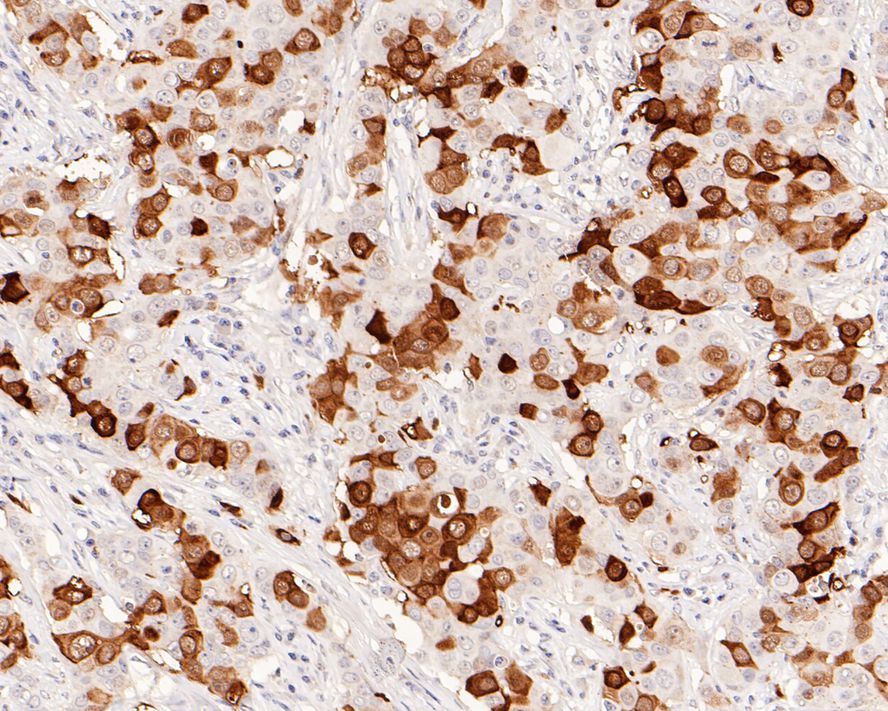 Immunohistochemical analysis of paraffin-embedded human breast carcinoma tissue with Rabbit anti-Phospho-Cdk2(Y15) antibody (ET1611-52) at 1/1,000 dilution.<br />
<br />
The section was pre-treated using heat mediated antigen retrieval with sodium citrate buffer (pH 6.0) for 2 minutes. The tissues were blocked in 1% BSA for 20 minutes at room temperature, washed with ddH2O and PBS, and then probed with the primary antibody (ET1611-52) at 1/1,000 dilution for 1 hour at room temperature. The detection was performed using an HRP conjugated compact polymer system. DAB was used as the chromogen. Tissues were counterstained with hematoxylin and mounted with DPX.