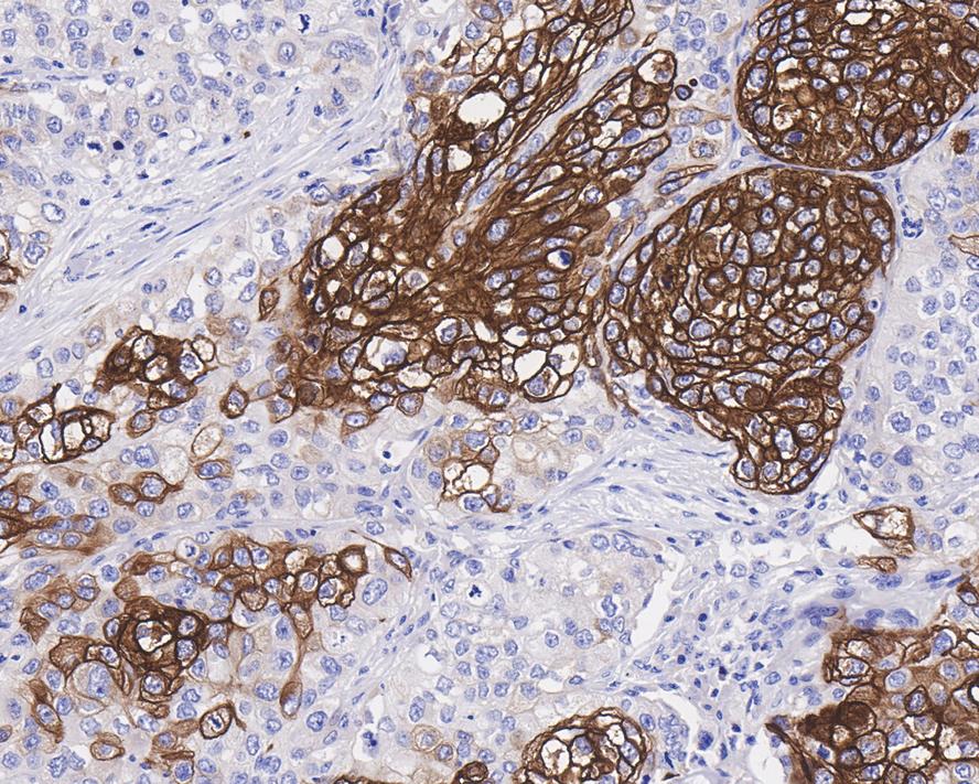 Immunohistochemical analysis of paraffin-embedded human breast carcinoma tissue using anti-Cytokeratin 13 antibody. The section was pre-treated using heat mediated antigen retrieval with Tris-EDTA buffer (pH 9.0) for 20 minutes.The tissues were blocked in 5% BSA for 30 minutes at room temperature, washed with ddH2O and PBS, and then probed with the primary antibody (ET1611-55, 1/50) for 30 minutes at room temperature. The detection was performed using an HRP conjugated compact polymer system. DAB was used as the chromogen. Tissues were counterstained with hematoxylin and mounted with DPX.
