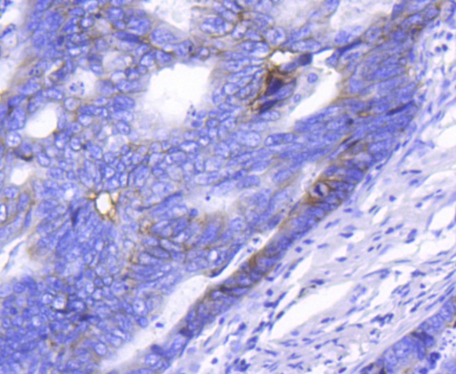 Immunohistochemical analysis of paraffin-embedded human breast carcinoma tissue using anti-Integrin alpha 2 antibody. The section was pre-treated using heat mediated antigen retrieval with Tris-EDTA buffer (pH 8.0-8.4) for 20 minutes.The tissues were blocked in 5% BSA for 30 minutes at room temperature, washed with ddH2O and PBS, and then probed with the primary antibody (ET1611-57, 1/50) for 30 minutes at room temperature. The detection was performed using an HRP conjugated compact polymer system. DAB was used as the chromogen. Tissues were counterstained with hematoxylin and mounted with DPX.