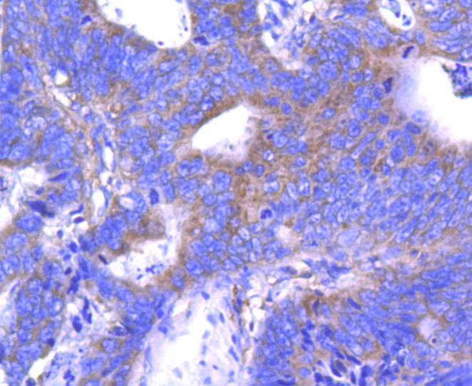 Immunohistochemical analysis of paraffin-embedded human colon carcinoma tissue using anti-ABCF1 antibody. The section was pre-treated using heat mediated antigen retrieval with Tris-EDTA buffer (pH 9.0) for 20 minutes.The tissues were blocked in 1% BSA for 30 minutes at room temperature, washed with ddH2O and PBS, and then probed with the primary antibody (ET1611-63, 1/50) for 30 minutes at room temperature. The detection was performed using an HRP conjugated compact polymer system. DAB was used as the chromogen. Tissues were counterstained with hematoxylin and mounted with DPX.