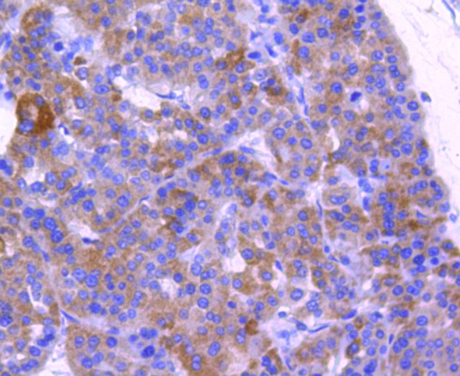Immunohistochemical analysis of paraffin-embedded human liver carcinoma tissue using anti-ABCF1 antibody. The section was pre-treated using heat mediated antigen retrieval with Tris-EDTA buffer (pH 9.0) for 20 minutes.The tissues were blocked in 1% BSA for 30 minutes at room temperature, washed with ddH2O and PBS, and then probed with the primary antibody (ET1611-63, 1/50) for 30 minutes at room temperature. The detection was performed using an HRP conjugated compact polymer system. DAB was used as the chromogen. Tissues were counterstained with hematoxylin and mounted with DPX.
