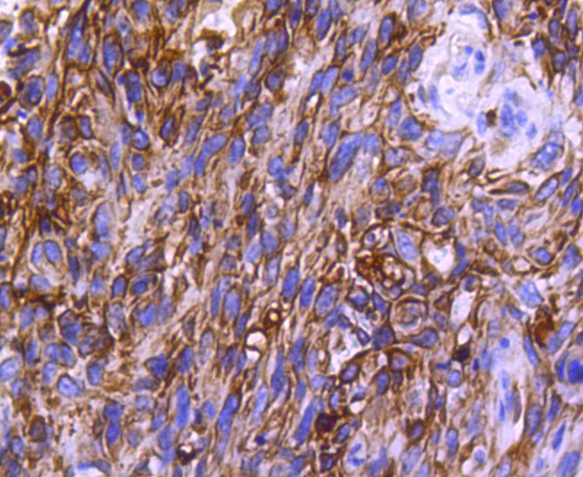 Immunohistochemical analysis of paraffin-embedded human breast carcinoma tissue using anti-CCR2 antibody. The section was pre-treated using heat mediated antigen retrieval with Tris-EDTA buffer (pH 8.0-8.4) for 20 minutes.The tissues were blocked in 5% BSA for 30 minutes at room temperature, washed with ddH2O and PBS, and then probed with the primary antibody (ET1611-65, 1/50) for 30 minutes at room temperature. The detection was performed using an HRP conjugated compact polymer system. DAB was used as the chromogen. Tissues were counterstained with hematoxylin and mounted with DPX.