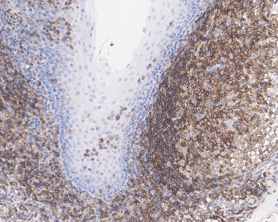 Immunohistochemical analysis of paraffin-embedded human breast carcinoma tissue using anti-Phospho-Chk1 (S296) antibody. The section was pre-treated using heat mediated antigen retrieval with Tris-EDTA buffer (pH 8.0-8.4) for 20 minutes.The tissues were blocked in 5% BSA for 30 minutes at room temperature, washed with ddH2O and PBS, and then probed with the primary antibody (ET1611-76, 1/50) for 30 minutes at room temperature. The detection was performed using an HRP conjugated compact polymer system. DAB was used as the chromogen. Tissues were counterstained with hematoxylin and mounted with DPX.