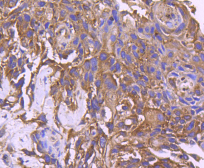 Immunohistochemical analysis of paraffin-embedded human breast carcinoma tissue using anti-CD10 antibody. The section was pre-treated using heat mediated antigen retrieval with Tris-EDTA buffer (pH 8.0-8.4) for 20 minutes.The tissues were blocked in 5% BSA for 30 minutes at room temperature, washed with ddH2O and PBS, and then probed with the primary antibody (ET1611-82, 1/50) for 30 minutes at room temperature. The detection was performed using an HRP conjugated compact polymer system. DAB was used as the chromogen. Tissues were counterstained with hematoxylin and mounted with DPX.