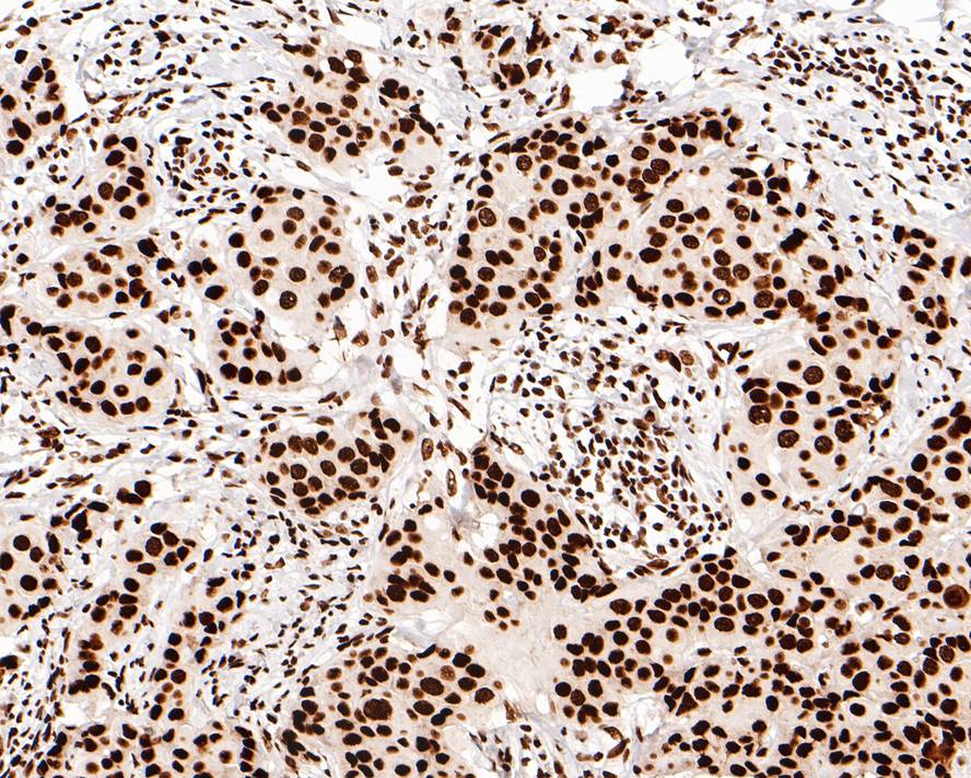 Immunohistochemical analysis of paraffin-embedded human kidney tissue with Rabbit anti-BRG1 antibody (ET1611-85) at 1/500 dilution.<br />
<br />
The section was pre-treated using heat mediated antigen retrieval with sodium citrate buffer (pH 6.0) for 2 minutes. The tissues were blocked in 1% BSA for 20 minutes at room temperature, washed with ddH2O and PBS, and then probed with the primary antibody (ET1611-85) at 1/500 dilution for 1 hour at room temperature. The detection was performed using an HRP conjugated compact polymer system. DAB was used as the chromogen. Tissues were counterstained with hematoxylin and mounted with DPX.