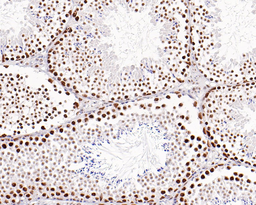 Immunohistochemical analysis of paraffin-embedded human breast carcinoma tissue with Rabbit anti-BRG1 antibody (ET1611-85) at 1/500 dilution.<br />
<br />
The section was pre-treated using heat mediated antigen retrieval with sodium citrate buffer (pH 6.0) for 2 minutes. The tissues were blocked in 1% BSA for 20 minutes at room temperature, washed with ddH2O and PBS, and then probed with the primary antibody (ET1611-85) at 1/500 dilution for 1 hour at room temperature. The detection was performed using an HRP conjugated compact polymer system. DAB was used as the chromogen. Tissues were counterstained with hematoxylin and mounted with DPX.