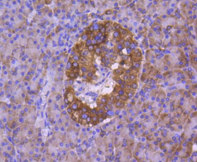 Immunohistochemical analysis of paraffin-embedded human liver carcinoma tissue using anti-Calnexin antibody. The section was pre-treated using heat mediated antigen retrieval with Tris-EDTA buffer (pH 8.0-8.4) for 20 minutes.The tissues were blocked in 5% BSA for 30 minutes at room temperature, washed with ddH2O and PBS, and then probed with the primary antibody (ET1611-86, 1/50) for 30 minutes at room temperature. The detection was performed using an HRP conjugated compact polymer system. DAB was used as the chromogen. Tissues were counterstained with hematoxylin and mounted with DPX.