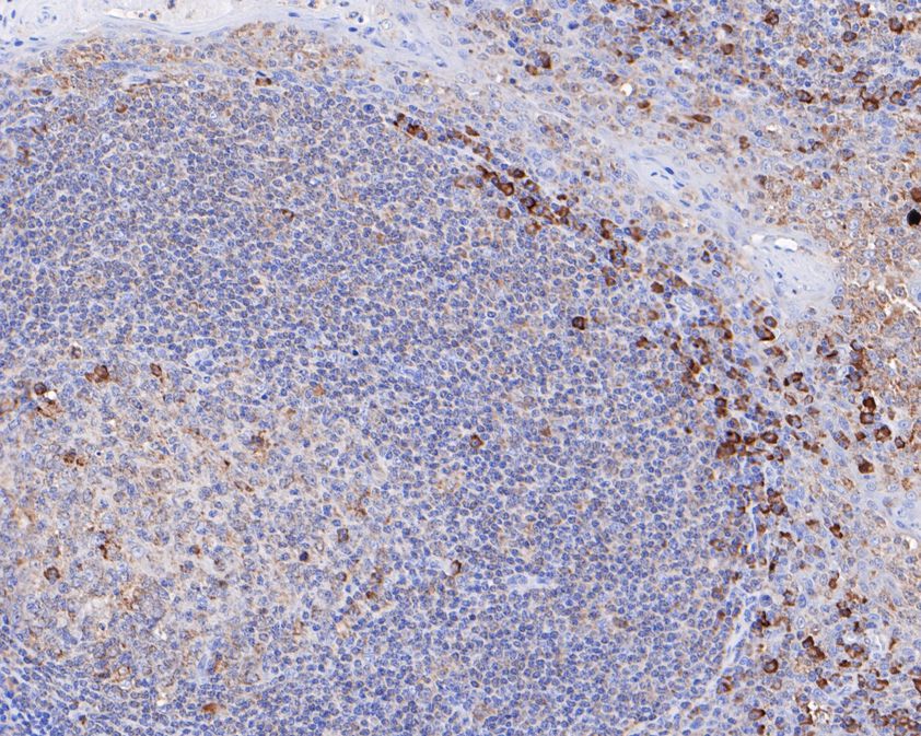 Immunohistochemical analysis of paraffin-embedded human tonsil tissue using anti-IRF5 antibody. The section was pre-treated using heat mediated antigen retrieval with sodium citrate buffer (pH 6.0) for 20 minutes. The tissues were blocked in 5% BSA for 30 minutes at room temperature, washed with ddH2O and PBS, and then probed with the primary antibody (ET1611-94, 1/200)  for 30 minutes at room temperature. The detection was performed using an HRP conjugated compact polymer system. DAB was used as the chromogen. Tissues were counterstained with hematoxylin and mounted with DPX.