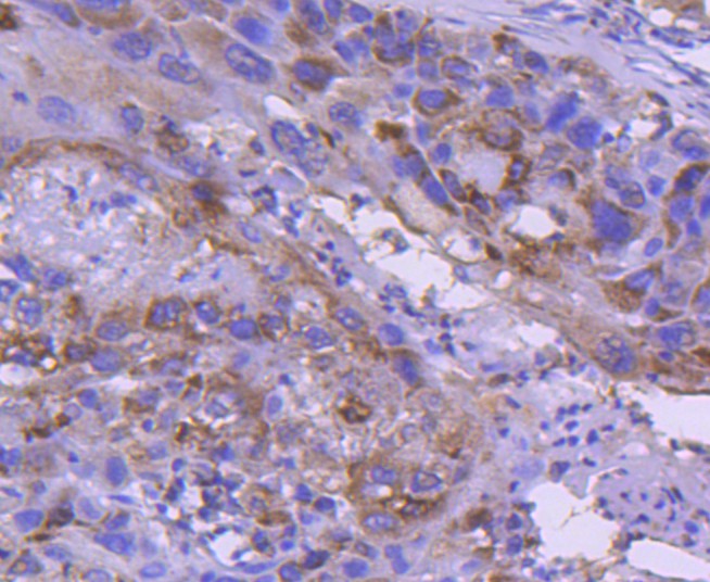 Immunohistochemical analysis of paraffin-embedded human lung carcinoma tissue using anti-IRF5 antibody. The section was pre-treated using heat mediated antigen retrieval with Tris-EDTA buffer (pH 8.0-8.4) for 20 minutes.The tissues were blocked in 5% BSA for 30 minutes at room temperature, washed with ddH2O and PBS, and then probed with the primary antibody (ET1611-94, 1/50) for 30 minutes at room temperature. The detection was performed using an HRP conjugated compact polymer system. DAB was used as the chromogen. Tissues were counterstained with hematoxylin and mounted with DPX.