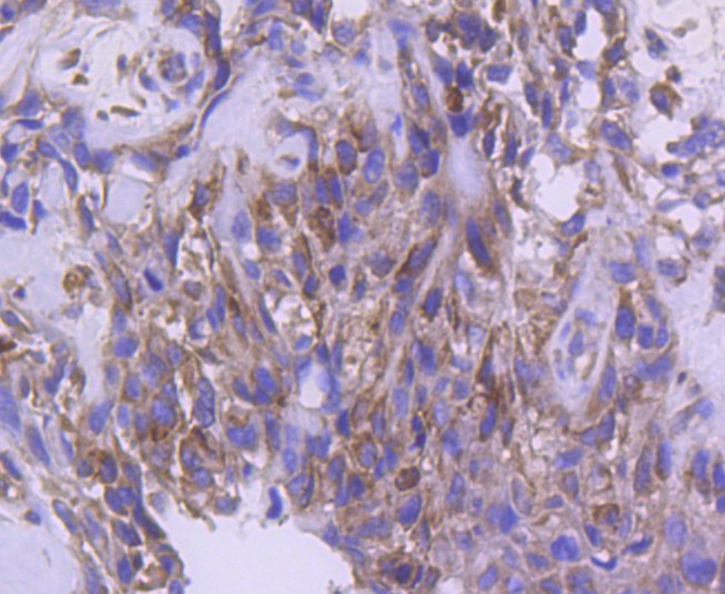 Immunohistochemical analysis of paraffin-embedded human breast carcinoma tissue using anti-IRF5 antibody. The section was pre-treated using heat mediated antigen retrieval with Tris-EDTA buffer (pH 8.0-8.4) for 20 minutes.The tissues were blocked in 5% BSA for 30 minutes at room temperature, washed with ddH2O and PBS, and then probed with the primary antibody (ET1611-94, 1/50) for 30 minutes at room temperature. The detection was performed using an HRP conjugated compact polymer system. DAB was used as the chromogen. Tissues were counterstained with hematoxylin and mounted with DPX.