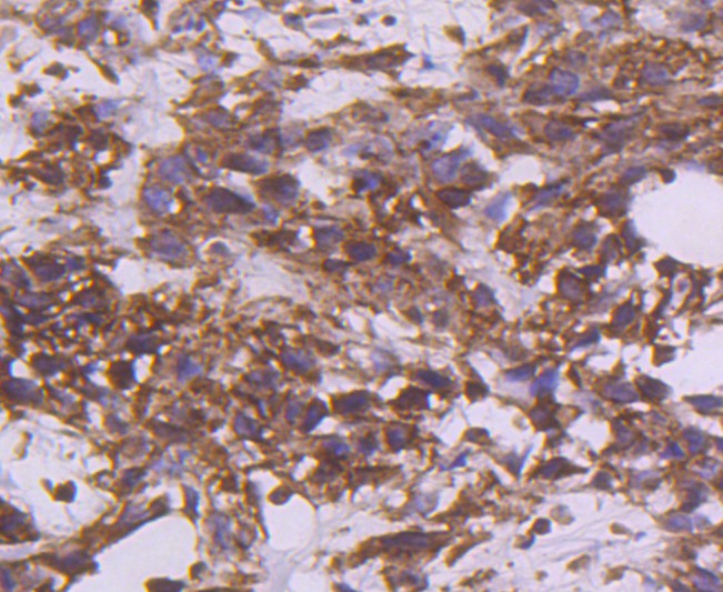 Immunohistochemical analysis of paraffin-embedded human breast carcinoma tissue using anti-Tissue Factor antibody. The section was pre-treated using heat mediated antigen retrieval with Tris-EDTA buffer (pH 8.0-8.4) for 20 minutes.The tissues were blocked in 5% BSA for 30 minutes at room temperature, washed with ddH2O and PBS, and then probed with the primary antibody (ET1611-95, 1/50) for 30 minutes at room temperature. The detection was performed using an HRP conjugated compact polymer system. DAB was used as the chromogen. Tissues were counterstained with hematoxylin and mounted with DPX.