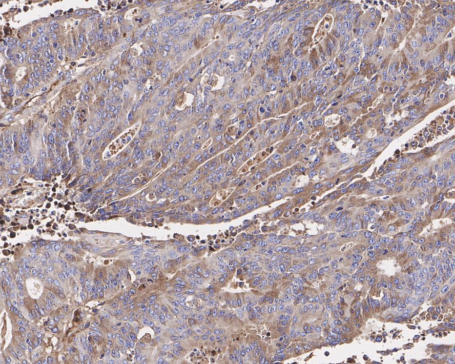 Immunohistochemical analysis of paraffin-embedded human colon carcinoma tissue using anti-RAB7 antibody. The section was pre-treated using heat mediated antigen retrieval with Tris-EDTA buffer (pH 8.0-8.4) for 20 minutes.The tissues were blocked in 5% BSA for 30 minutes at room temperature, washed with ddH2O and PBS, and then probed with the primary antibody (ET1611-96, 1/50) for 30 minutes at room temperature. The detection was performed using an HRP conjugated compact polymer system. DAB was used as the chromogen. Tissues were counterstained with hematoxylin and mounted with DPX.